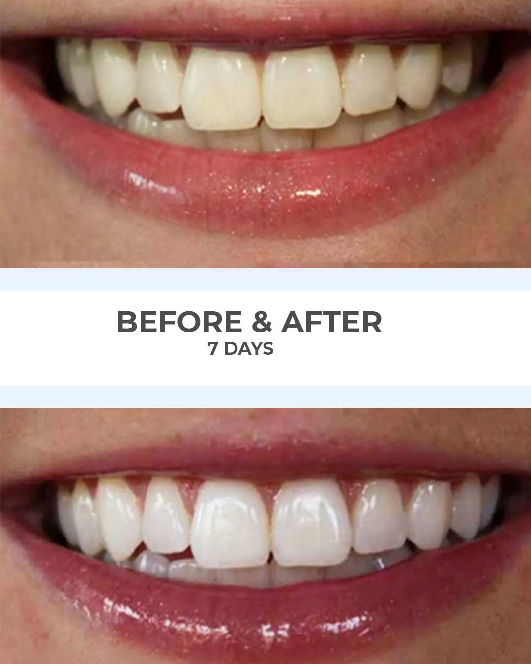 SmilePro before and after result