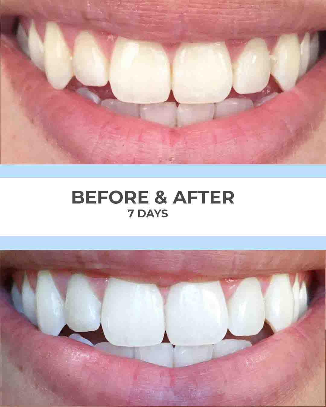 SmilePro before and after result